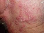 Dermatitis Seborrhoica
