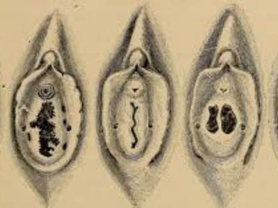 Hymen imperforatus je urođena anomalija u vidu opne između introitusa vagine i vagine.