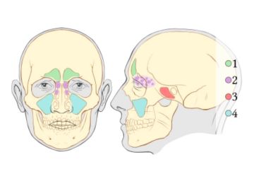 Upala sinusa (sinusitis ili rinosinuzitis)